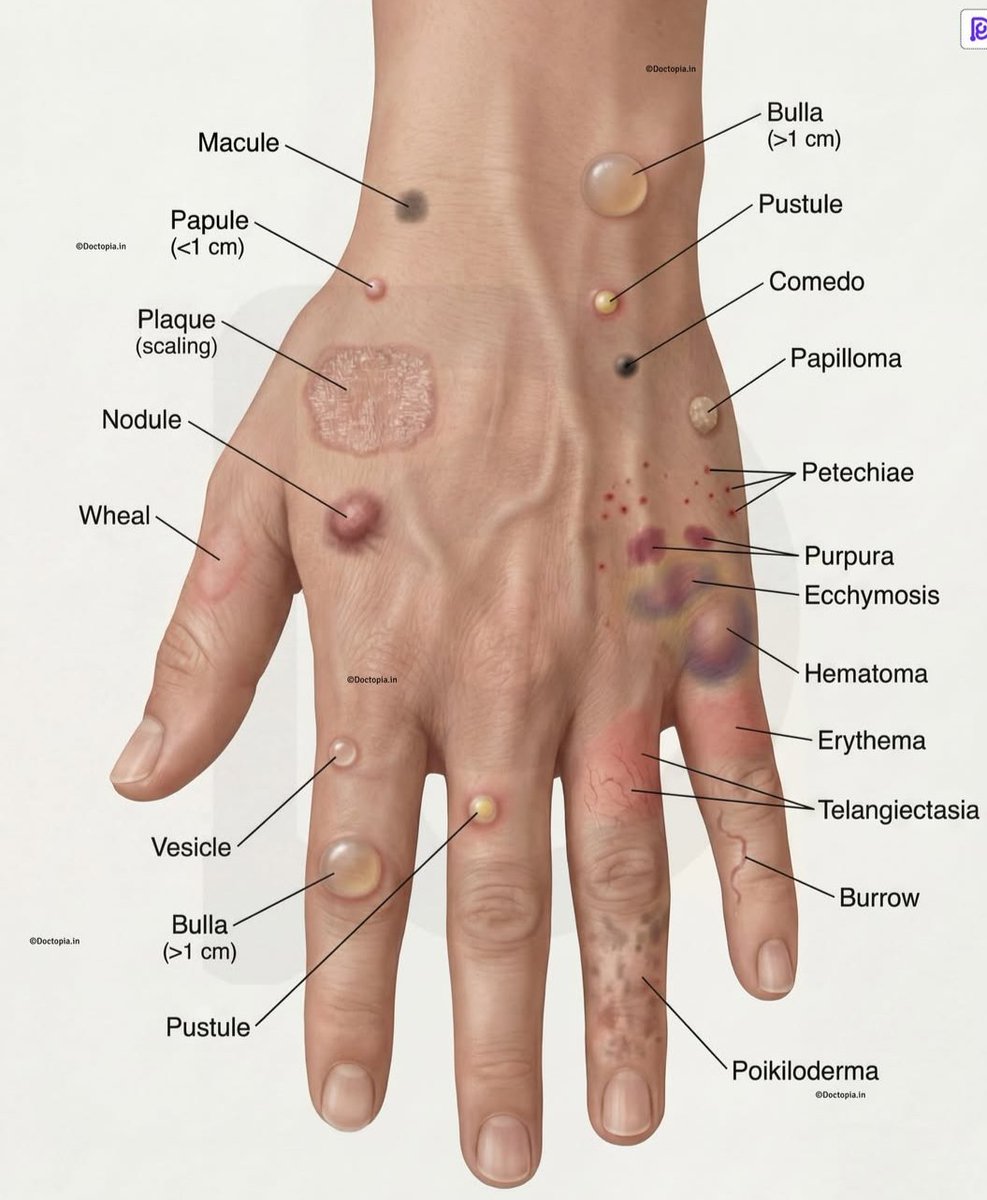 Doctors_GUILD's tweet photo. Important Skin lesion.... https://t.co/0a7Az0oWLE