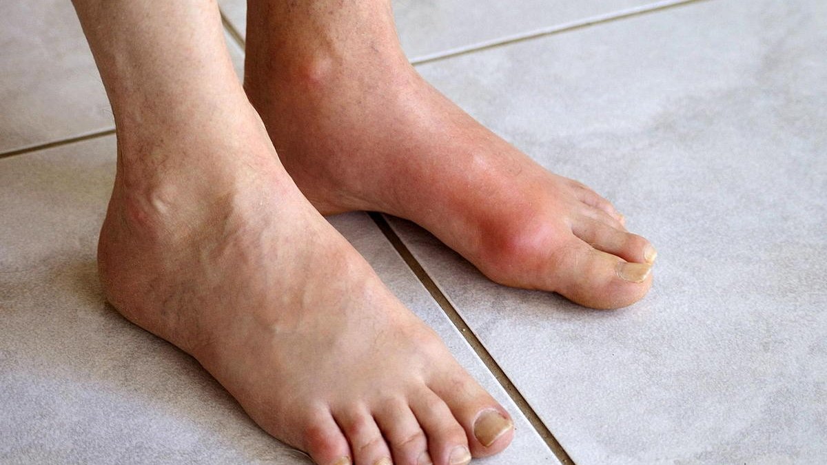 أعراض سرطان العظام في القدم: علامات خفية قد نهملها دون انتباه 