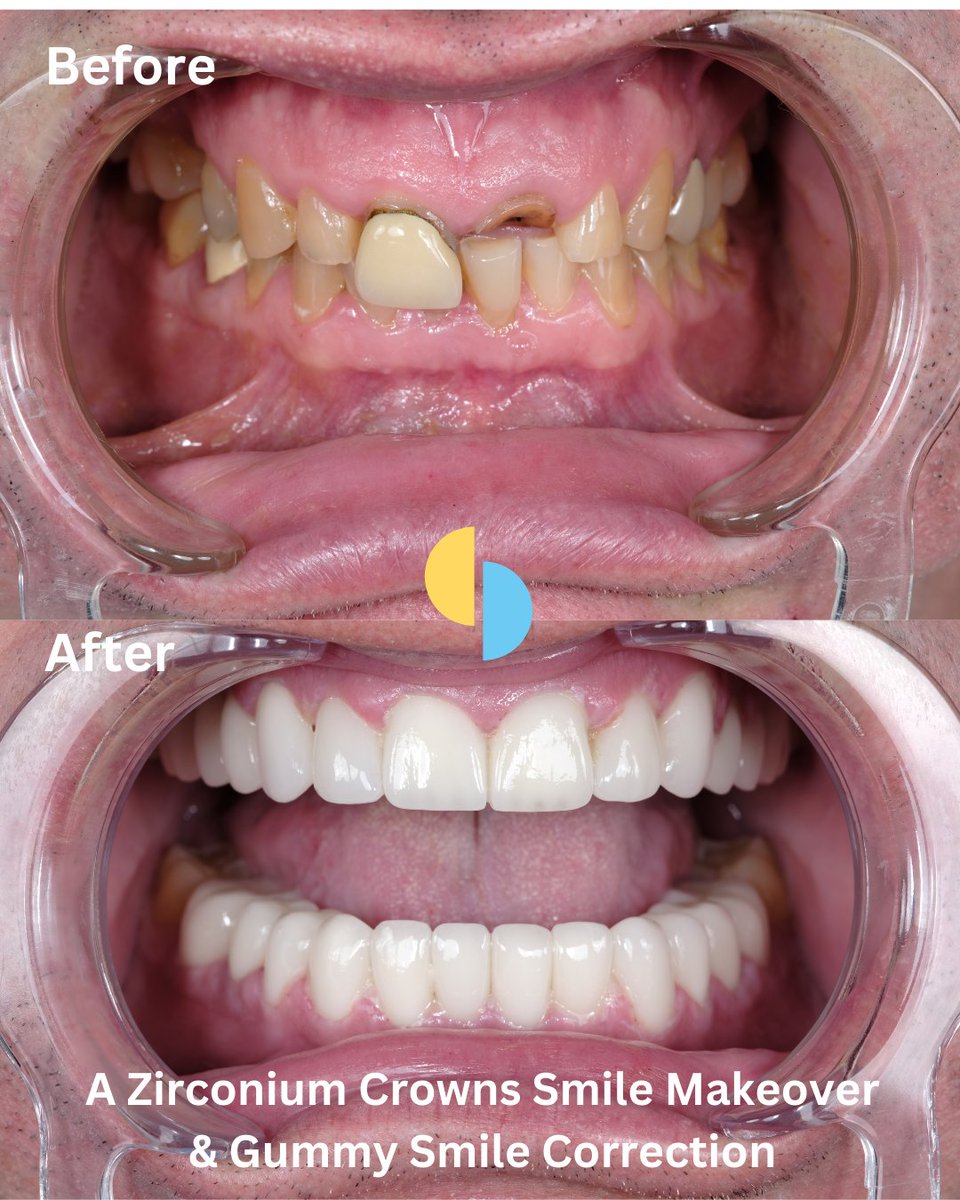 It’s not just about the teeth. It’s about the frame. 🖼️✨

A beautiful smile requires a balance between “White Aesthetics” (the teeth) and “Pink Aesthetics” (the gums).

For our patient Paul, we didn’t use generic tools. Our doctors performed Precision Surgical Gum Sculpting by