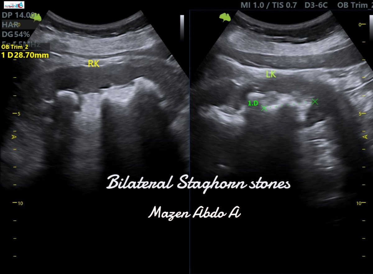 mznljrdy47597's tweet photo. Ultrasound cases  from  my daily practice 
Staghorn Renal Calculus  
 is a large renal calculus that occupies the renal pelvis and extends into the calyces, forming a characteristic branching appearance.

#Ultrasound #StaghornCalculus   #sonologist https://t.co/tYJvwJMjj1