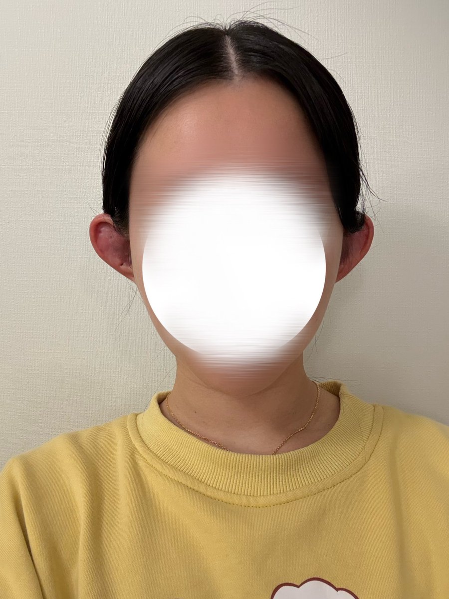 ちゃ❕DT眉下傷跡修正 逆さまつげ修正 𝐍𝐞𝐱𝐭二重修正 豊胸 tweet media