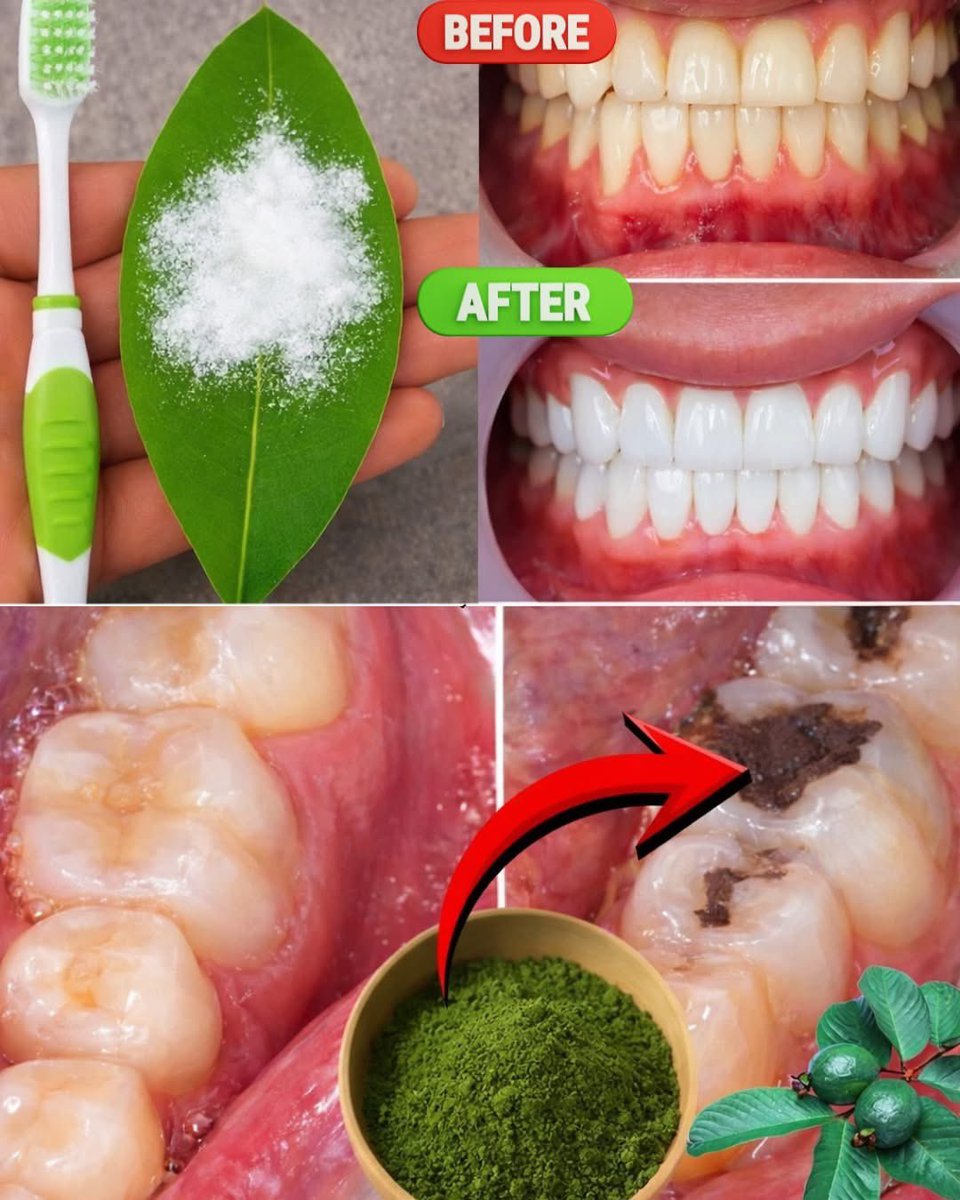 Guava leaves, support, oral, and gum health.

They contain natural flavonoids and tannins that help produce plaque find bacteria and pramod fresh with and stronger gums.

Consistent use may help you notice cleaner teeth naturally.

Boil five leaves in one cup, water reels daily.