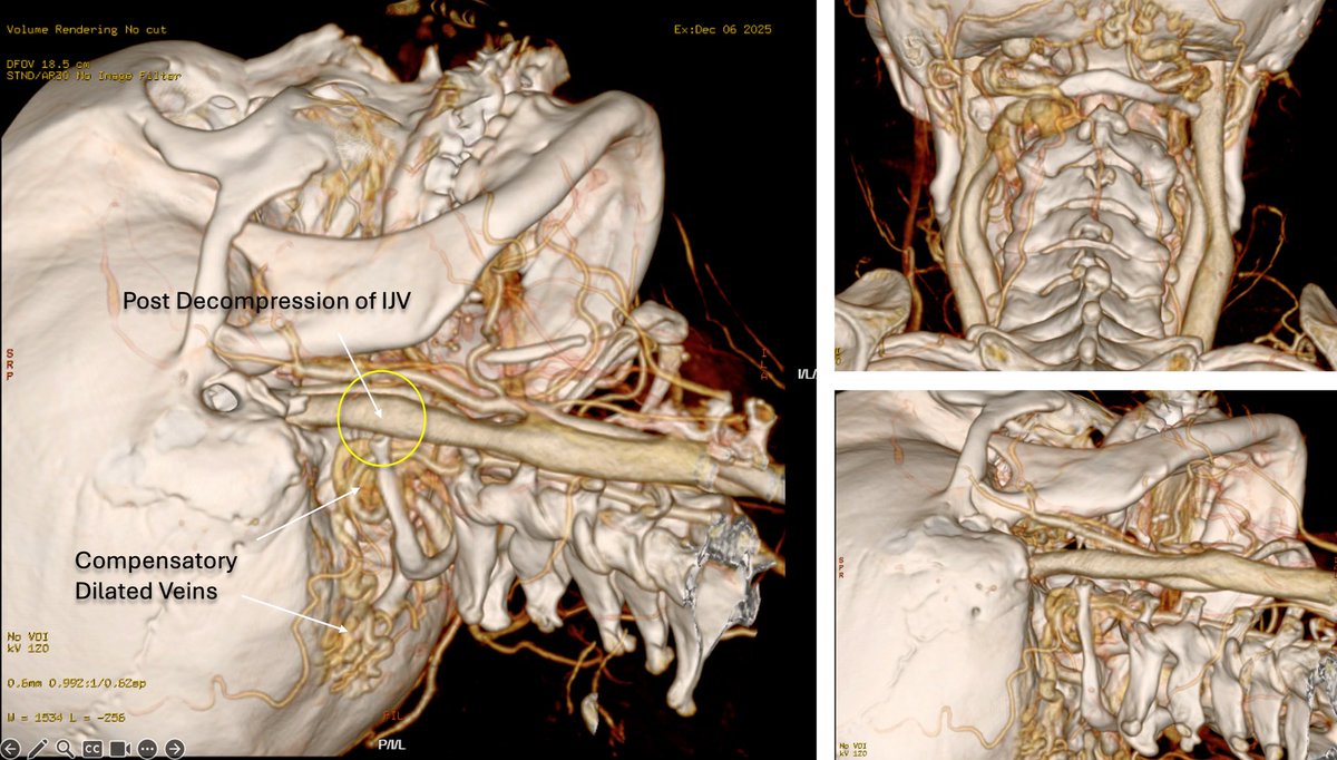 James K. Liu, MD tweet media