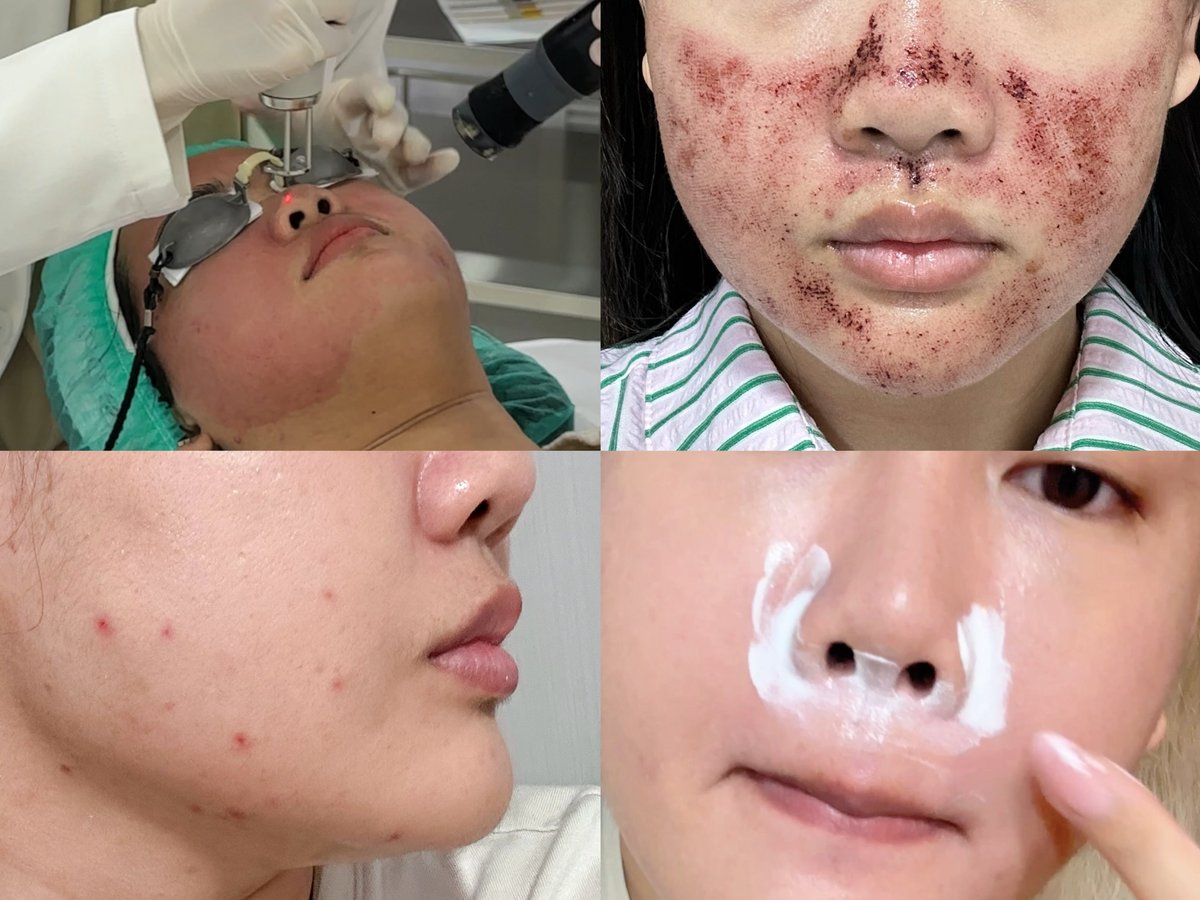 SujarSujarii's tweet image. ผิวมีปัญหาคิดไรไม่ออก จาจะนึกถึงลาโรช Cicaplast B5+ เป็นสิ่งแรก ตอนแรกหมอสกินแนะนำให้ใช้ฮีลลิ่งหลังทำหัตถการ/เลเซอร์/กดสิวทาได้หมด ใช้พอกตรงที่หน้าลอกก็ได้ ช่วงหน้าหนาวก็คือใช้บ่อย เข่า-ศอกแห้งก็ทาได้นะ ล่าสุดใช้กับงานแต่งหน้าด้วยแต้มปิดเกล็ดผิวที่ลอกดีมาก ควรมีติดบ้านไว้เลย