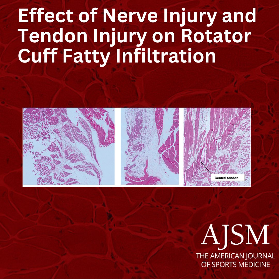 aossmjournals's tweet image. Rotator cuff tendon injury causes a more focal fatty infiltration along the NMJ and central tendon compared to a diffuse response from nerve injury. 

ow.ly/8vwr50XLz44

@MohitGilotraMD @UM_Ortho_MSKDiv  #RotatorCuff #Orthotwitter