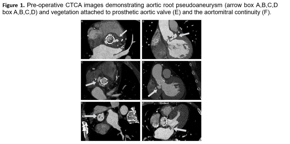 Journal of Cardiovascular CT tweet media