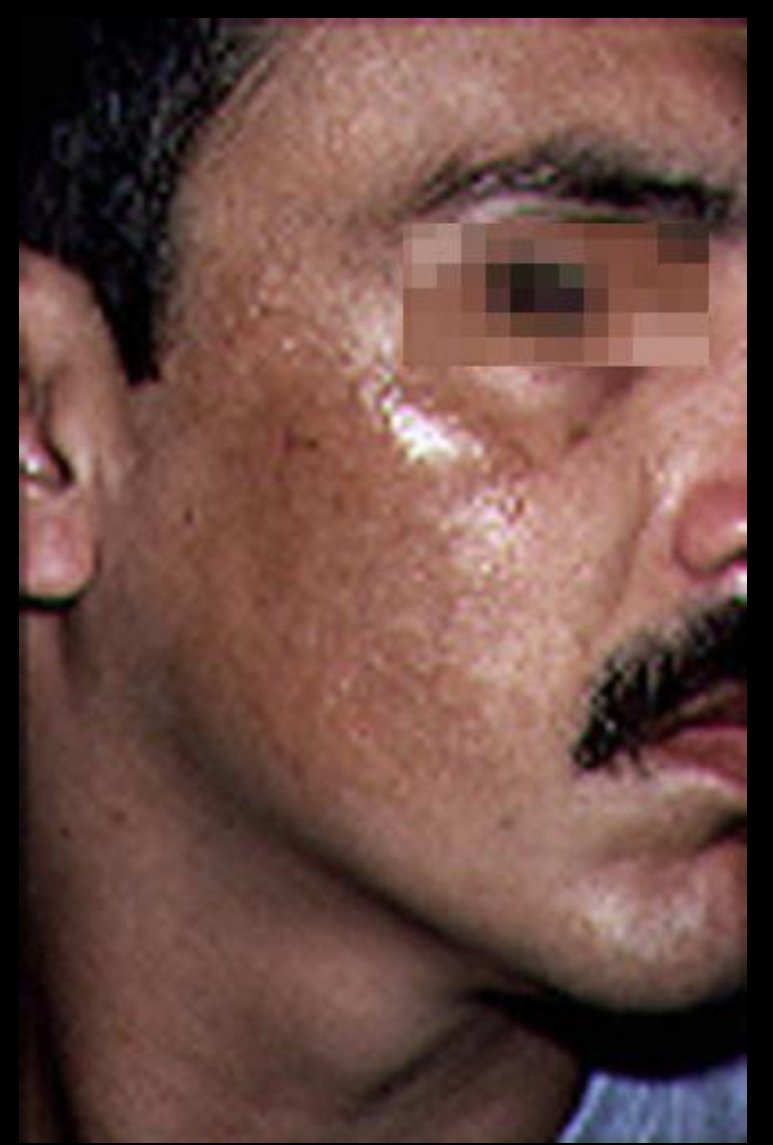 What's this??

#MedX

It occurs more frequently in females than in males and commonly develops or worsens during pregnancy and with the use of oral contraceptive pills.