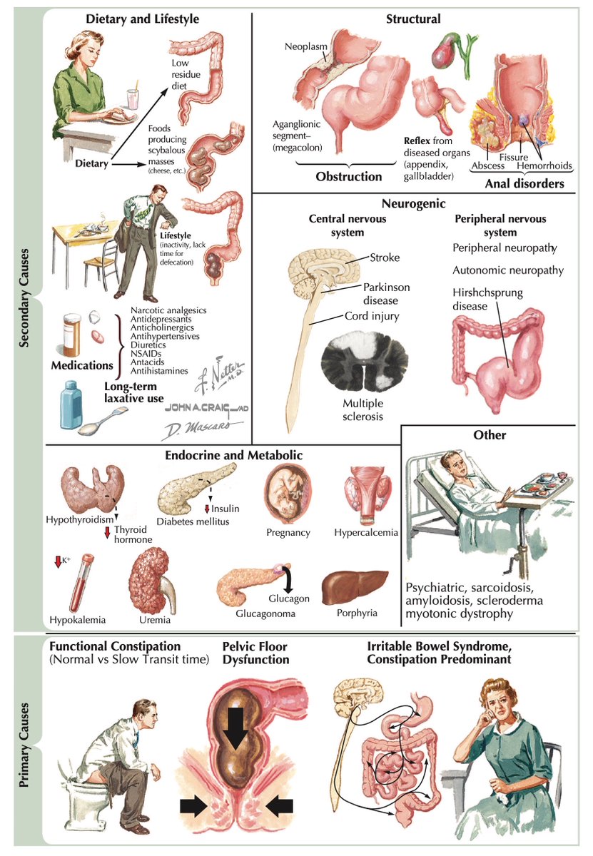 Resumen de las causas del estreñimiento #4KMedEd

📸: Fuente: #Netter