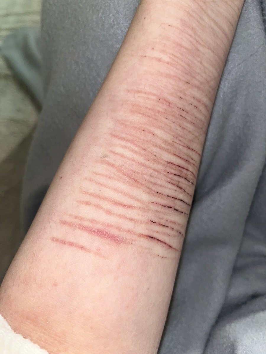 _josiez's tweet image. I feel like my scars are lowkey starting to fade or am i just delusional bro🥀