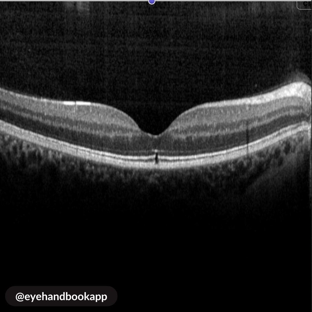 EyeHandbook's tweet photo. Macular Condition?
#eyes #cornea #clinicalcalculators #eyecalculators #eyeatlas #ophthalmologist #optometrist #eyedoctors #ophthalmology #optometry #cornea #ophthalmologyresident #retina #optometryresident #ophthalmologyapp #oftalmologia #eyesight #vision #slitlamp https://t.co/DhRZkDPHlM