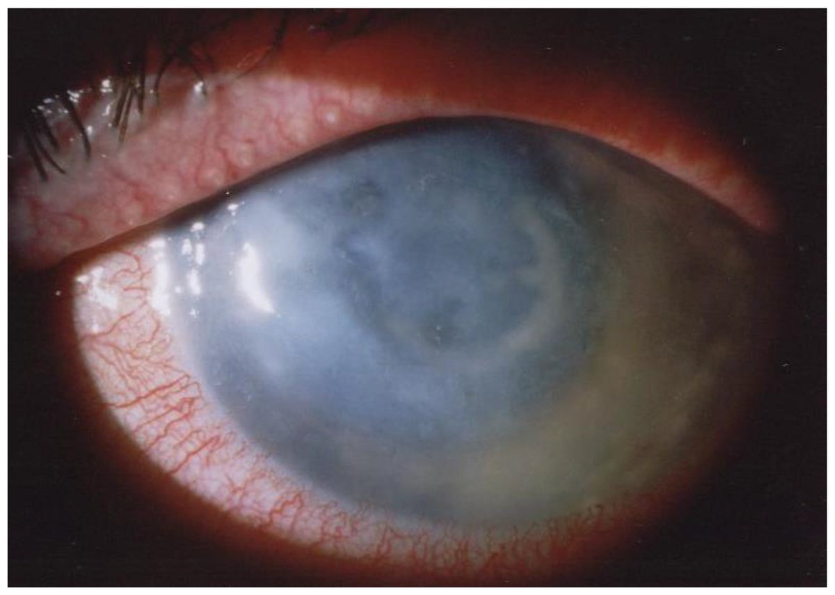 Micro_MDPI's tweet image. 👁️Acanthamoeba keratitis is a rare but potentially sight-threatening corneal infection with rising reported cases worldwide.

🔗mdpi.com/2076-2607/12/4…

#Acanthamoeba #Keratitis #Ophthalmology #InfectiousDiseases #EyeHealth