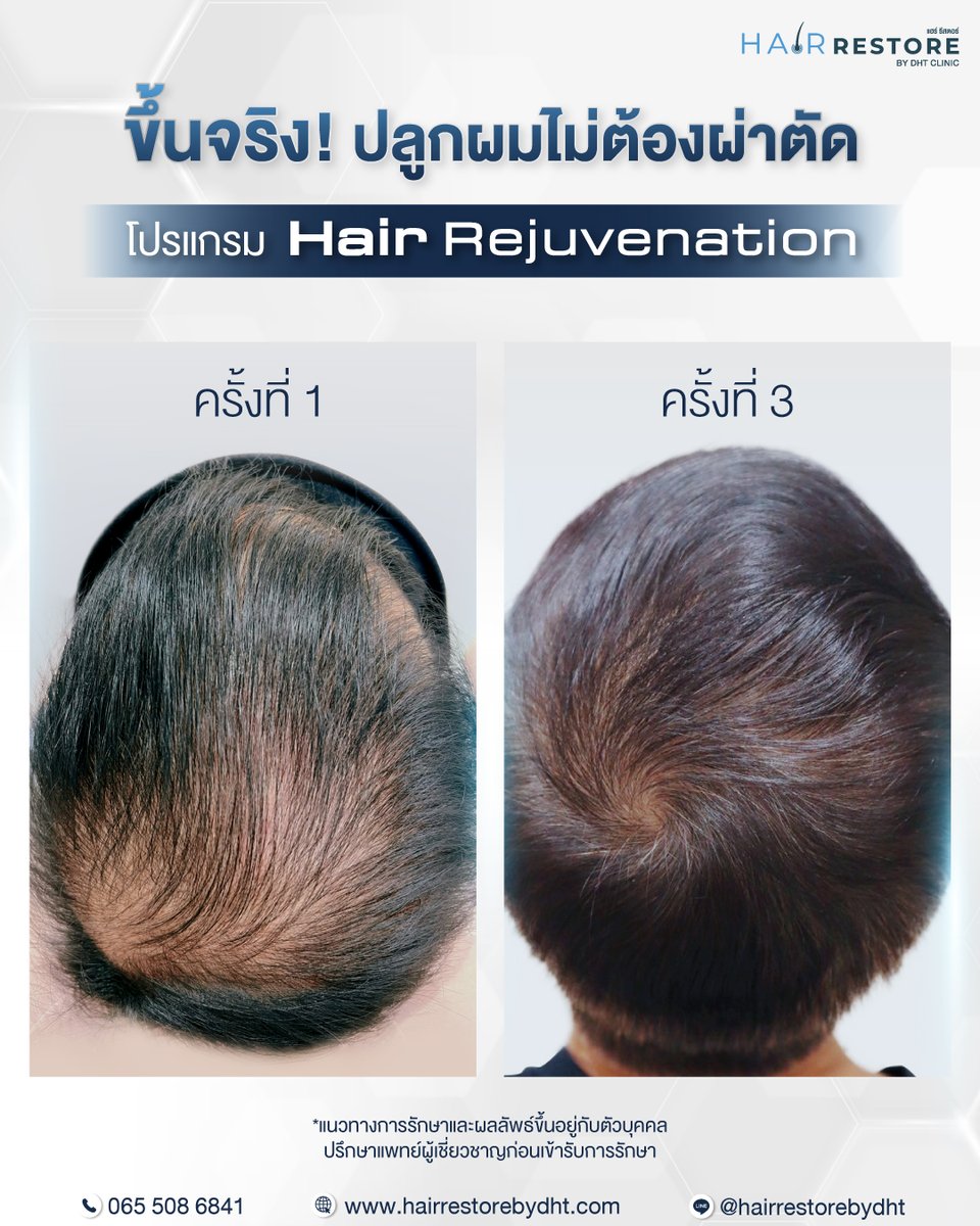 dhtluxclinic's tweet photo. Hair Rejuvenation Program - Hair Restoration Without Surgery!
Only 4 simple steps and done quickly within 30 minutes! 

Injection of concentrated blood plasma, rich in nutrients that directly help repair and regenerate hair follicle cells. https://t.co/0il7Ya9wVQ
