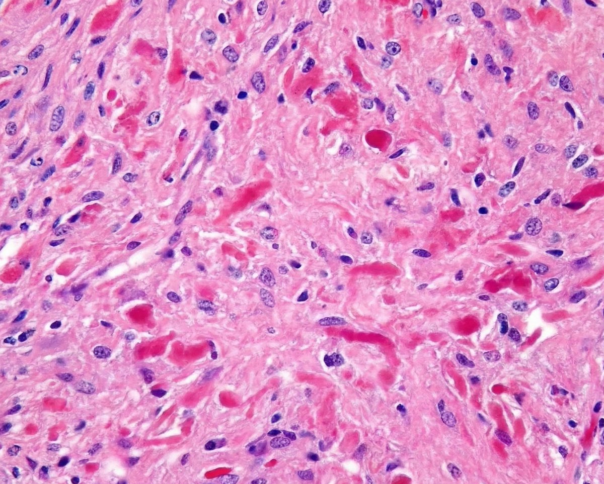 DrKamleshDarji1's tweet photo. What is the diagnosis? #MedTwitter #PathX https://t.co/UvDnrrrTJB