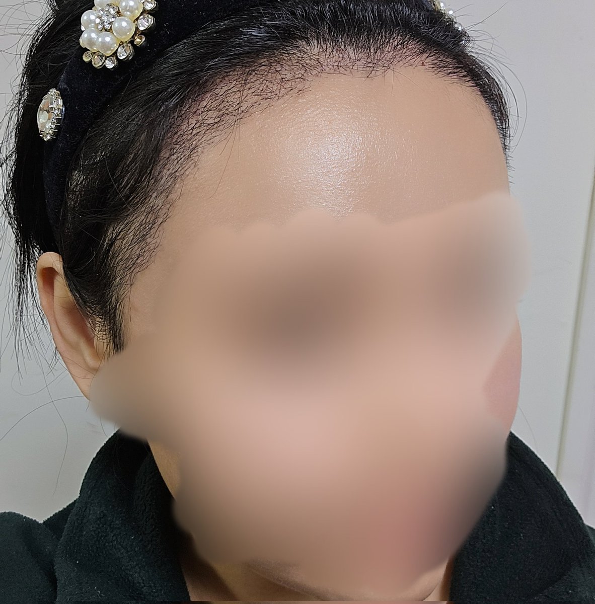 はむ韓国植毛輪郭骨切りダウンタイム中 tweet media