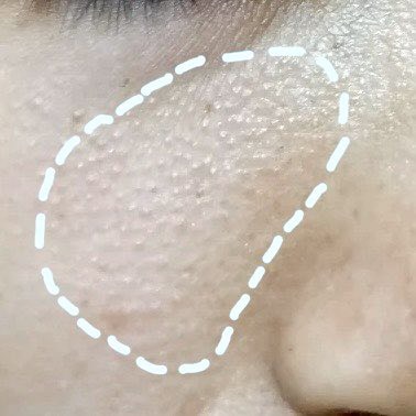 このトナーこういう毛孔性角化症にめっちゃオススメ。保湿したザラザラの方で拭き取るとスベスベ。