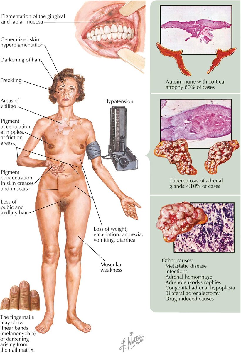 Tipos de anorexia - Mejor con Salud, image size:821x1200
