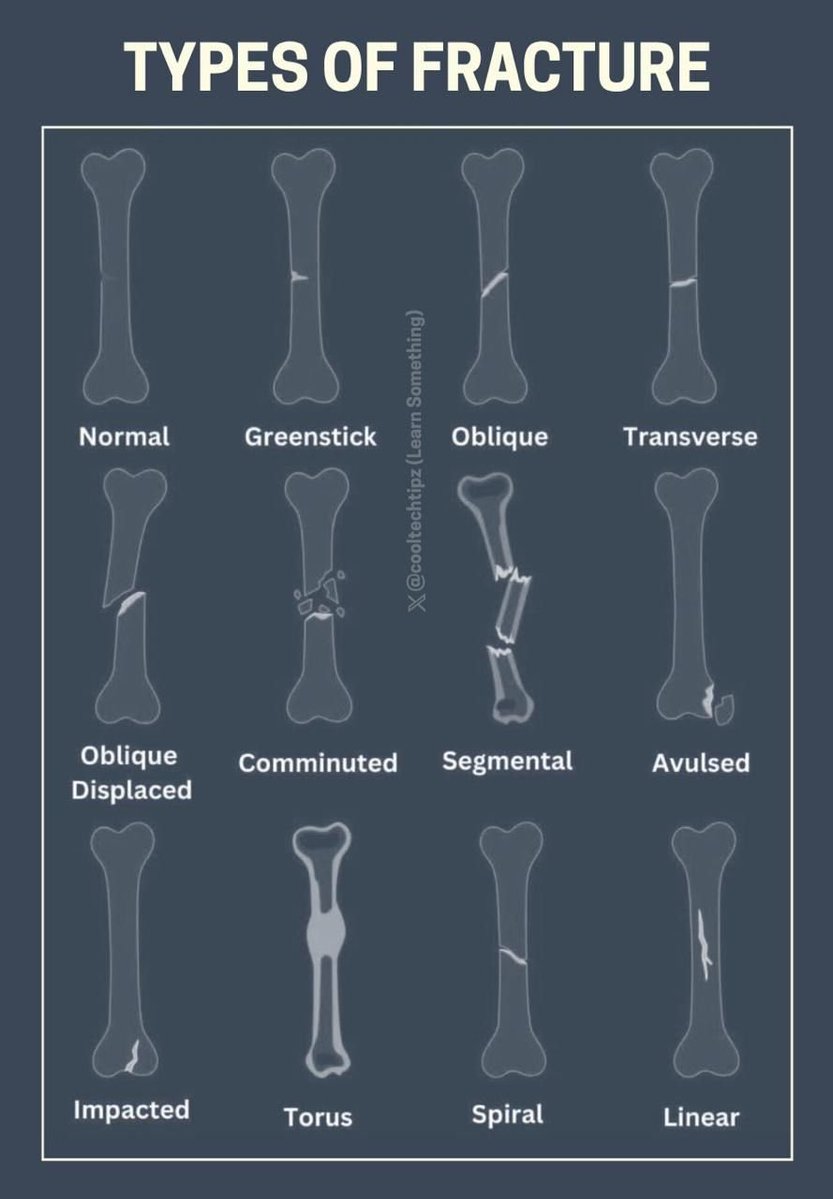 Post by Oren Gottfried, MD on X: Fracture