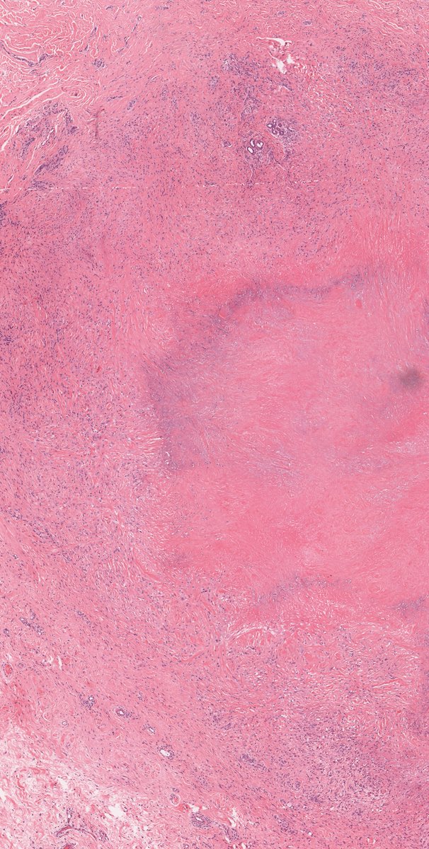 ❌Rheumatoid Nodule
The "Pink" mimic.
Found near joints in RA patients.
Deep palisaded granulomas with an acellular core of bright eosinophilic fibrin.
WSI: virtualpathology.leeds.ac.uk/slides/library…
