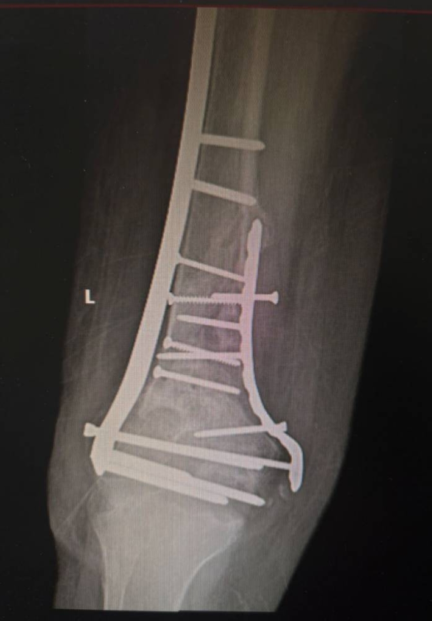 نجاح عملية جراحية معقدة ونادرة لاستبدال جزء من عظمة الفخذ وتغيير مفصل الركبة بـ مستشفى الملك فهد بالمدينة المنورة #المدينة_المنورة 