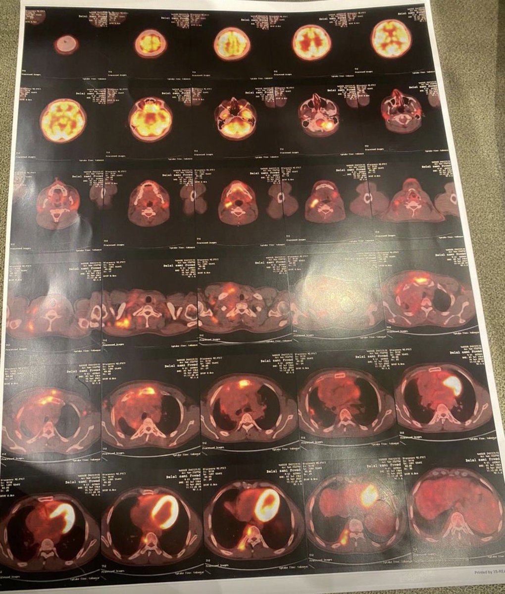 مناشدة لحالة خطيرة جداً ويجب أن يصل صوته قبل فوات الاوان

الشاب بلال غزال من غزة، قُصف منزلهم واستشهد والده ووالدته واصيب هو اصابة خطيرة.. تم إجلائه قبل فترة إلى الحبيبة مصر للعلاج من الإصابة وبعد فترة تم اكتشاف سرطان داخل جسده .. لم يستجب جسده للعلاج فانتشر السرطان بشكل أكبر