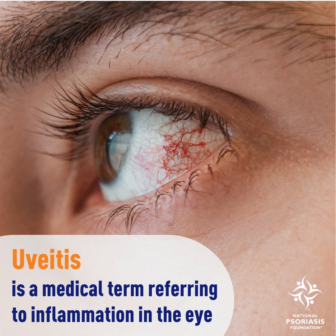 National Psoriasis Foundation tweet media