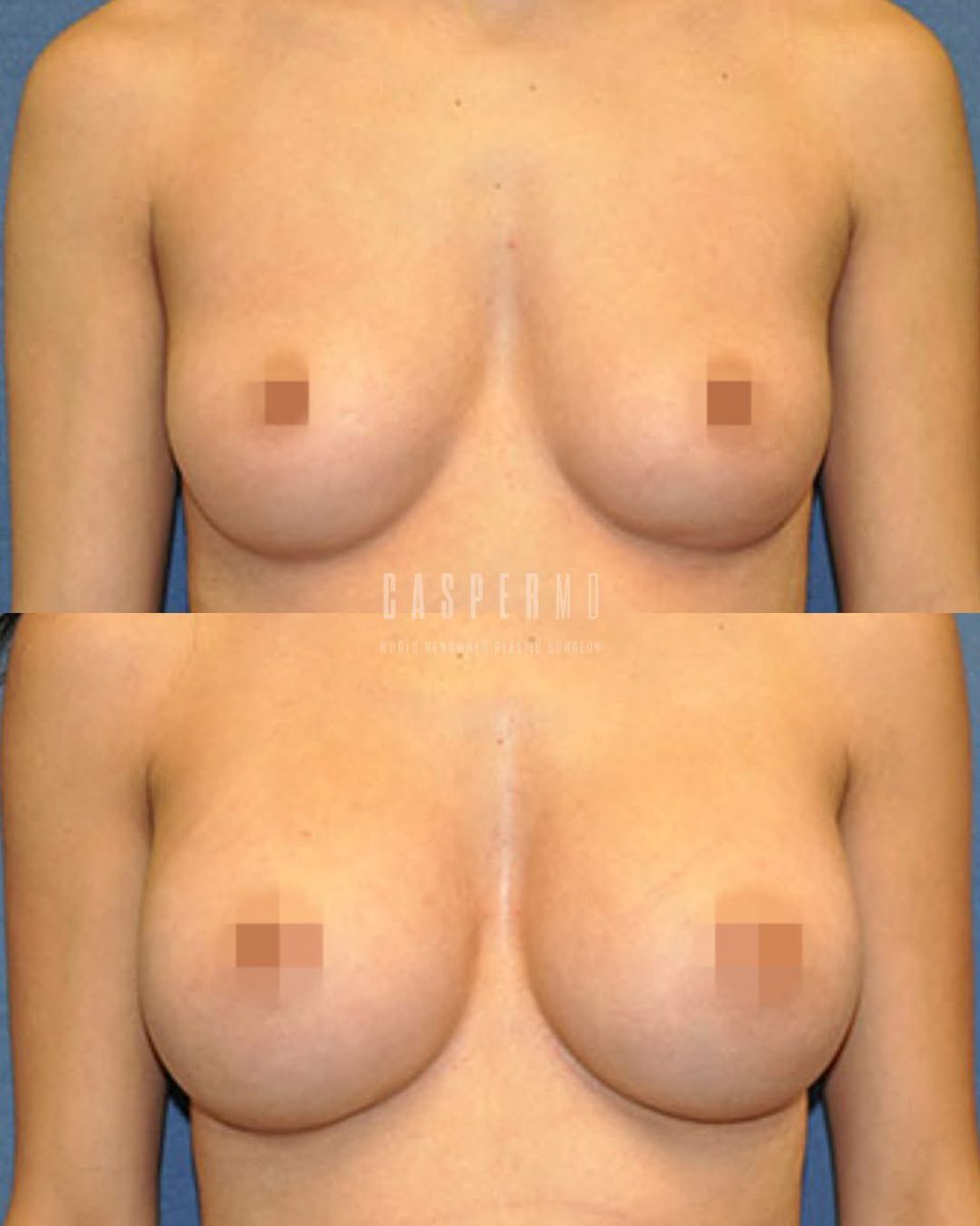 drdanielcasper's tweet image. A stunning transformation you can feel as much as you can see. ✨

These #BreastAugmentation results highlight Dr. Casper’s commitment to harmony, beauty, and patient-centered care. 💞

Discover what’s possible by checking out the link below!⁠

tinyurl.com/veun3dw7