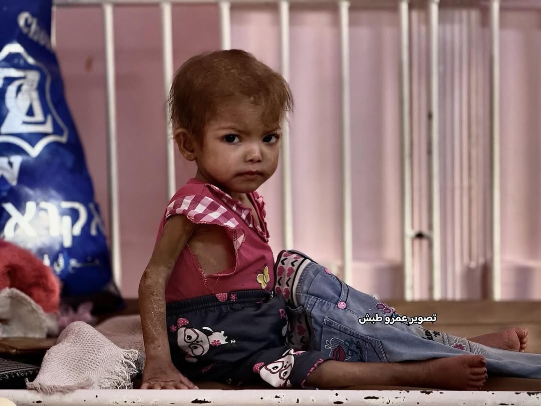 QudsNen's tweet photo. Four-year-old Palestinian Arjwan Al-Dahini faces a critical, life-threatening health condition after prolonged severe malnutrition, growth disorders, and acute protein deficiency, leaving her weight at just 5 kilograms.

She suffers hair loss, difficulty moving, speaking, and eating, along with chronic diarrhea, persistent vomiting, and kidney problems. Doctors suspect a serious illness but cannot confirm it due to the lack of medical equipment and diagnostic capabilities in Gaza. 

With no adequate treatment available, Arjwan’s condition continues to deteriorate, amid the Israeli ongoing blockade on medical aid.