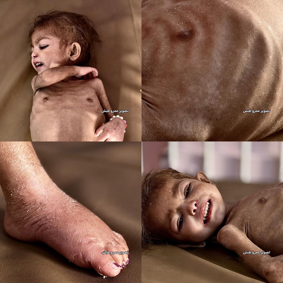 QudsNen's tweet image. A life-threatening health crisis is endangering four-year-old Palestinian child Arjwan Al-Dahini, whose condition has sharply deteriorated as a direct result of Israel’s blockade on the Gaza Strip.

After a prolonged battle with severe malnutrition, acute protein deficiency, and…