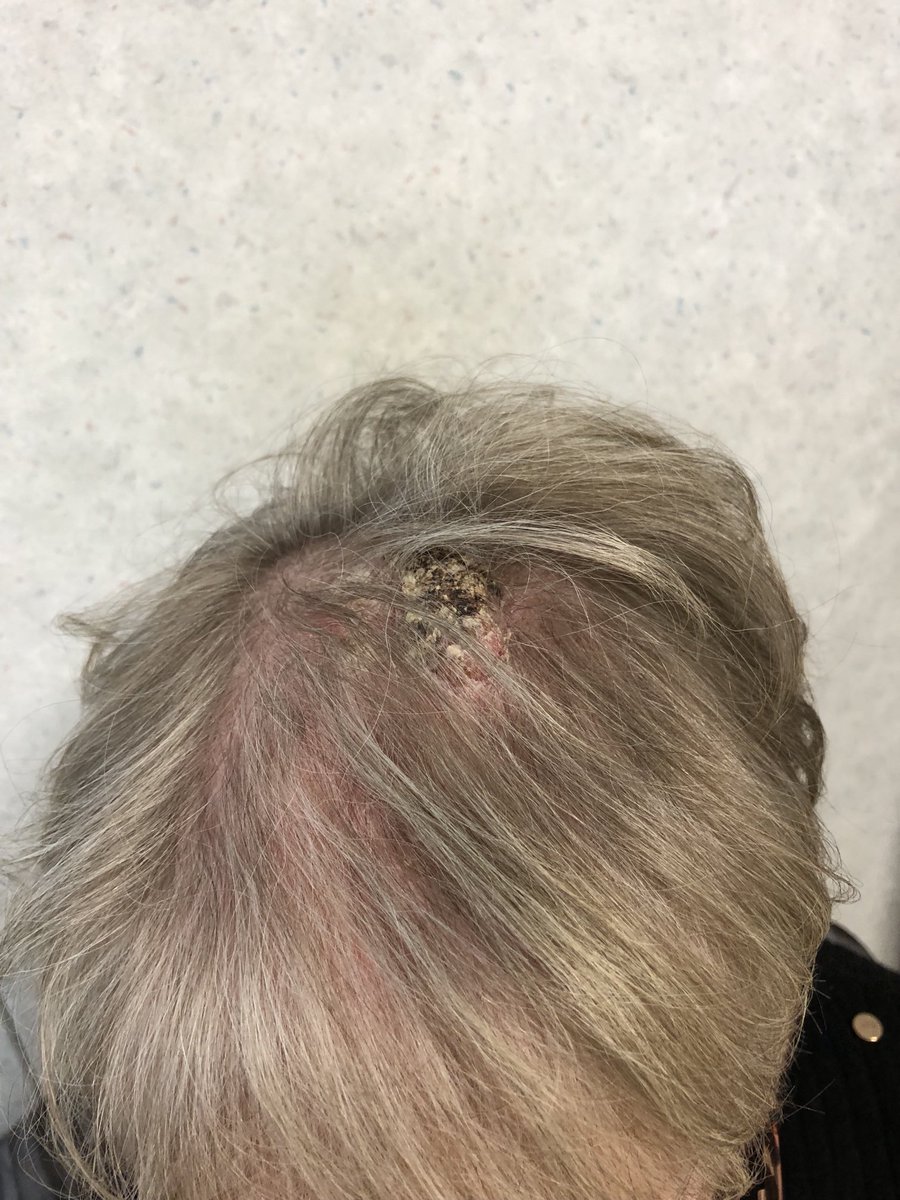 Janetbirdope's tweet image. #ClinicalPearl 

Raised growing lesion on scalp - bleeding on and off 
👇
no trauma, no #psoriasis 

Think 🤔 #cancer #malignancy !

#Diagnosis in 1 #picture