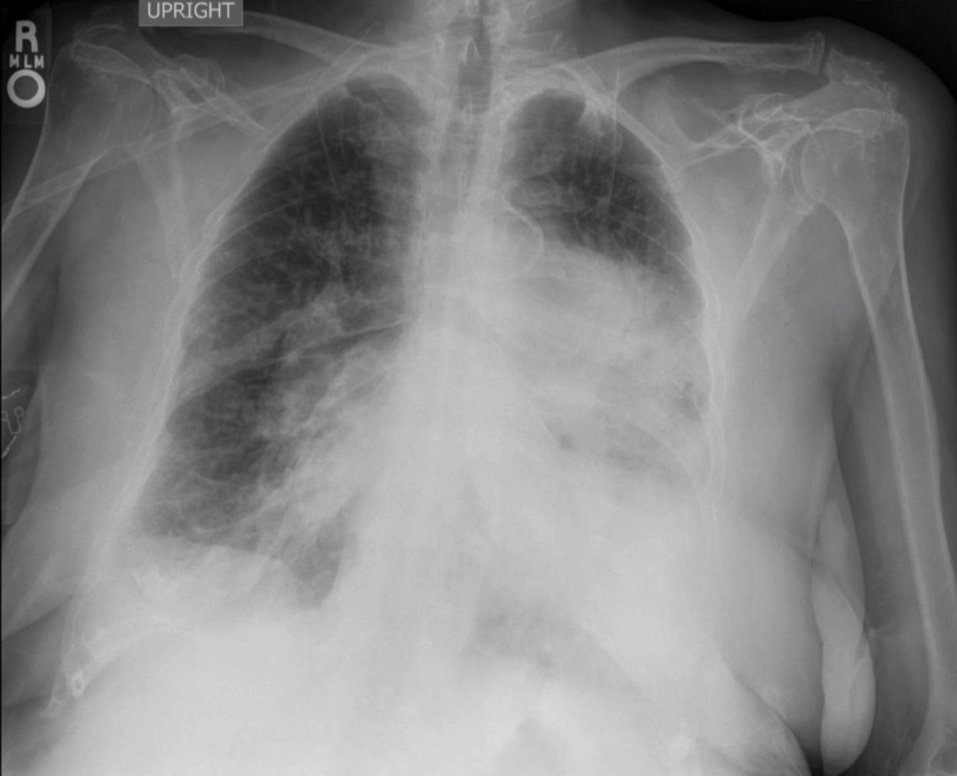 AndreMansoor's tweet image. New paper out in BMJ Case Reports 🫁

Radiograph reads pneumonia. . .but is it? Great example of why clinical context matters.

Proud to publish this with my brother @MansoorLabOHSU

casereports.bmj.com/content/18/10/…

#MedEd #Pulm #InternalMedicine #CaseReports #PulmHypertension