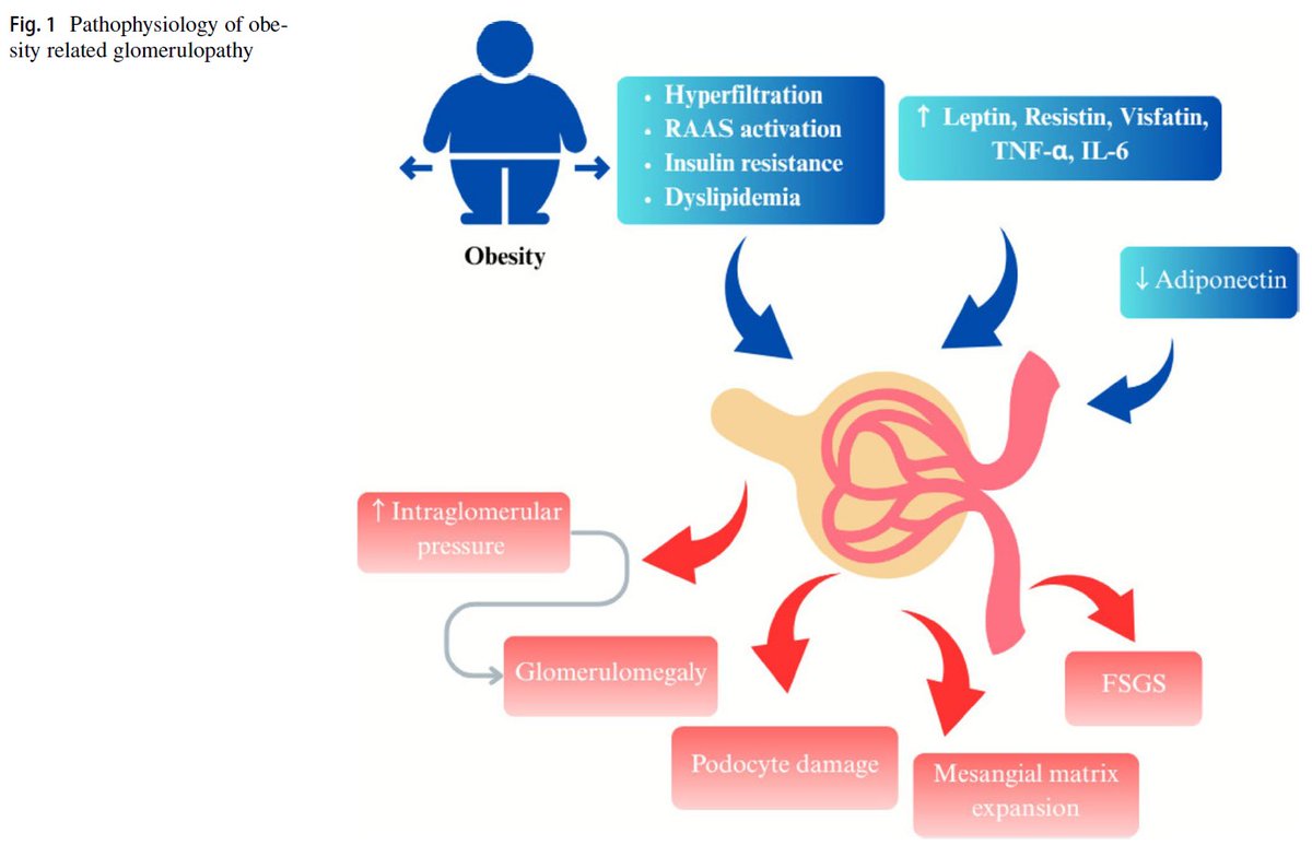 edgarvlermamd's tweet photo. Obesity‑related glomerulopathy, A growing kidney burden in the obesity pandemic ca. 2025 from @CenJournal @JZRenalPath @Koubar_Sahar @rahaai @SaynaNorouzi 
#Nephpearls

👉 https://t.co/49KIwt5Tni https://t.co/BsaFtnYzEi