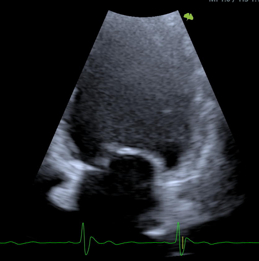 Prolapso de la valva mitral anterior...¿Que opinan? #echo #cardiotwitter