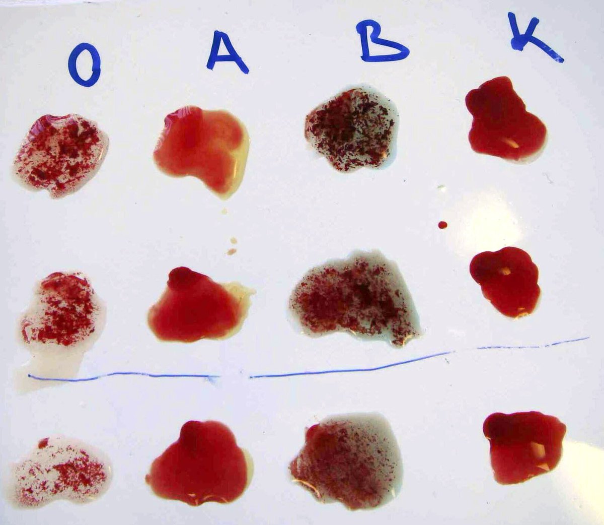 FishermanEduc's tweet photo. ❌Antibody จับเชื้อโรคแล้วตกตะกอน
✅Antibody ทำหน้าที่เหมือนป้ายแปะประจานเชื้อโรค ให้เซลล์ภูมิคุ้มกันเจอตัวและเข้าไปรุมยำตีนมันง่ายขึ้น (opsonization) และก็ช่วยให้เชื้อโรคแผลงฤทธิ์ได้ยากขึ้นด้วย (neutralization)
.
🩸เรามักติดภาพว่า antibody จับแล้วตกตะกอน (จริง ๆ ควรใช้คำว่า agglutination มากกว่า) มาจากตอนเราหยดสารเพื่อทดสอบหมู่เลือด ซึ่งมันไม่ใช่กลไกที่ร่างกายใช้กำจัดเชื้อโรค
.
ส่วนสภาพเม็ดเลือดแดงที่ agglutination แบบนั้นส่วนมากมันไม่ได้เกิดขึ้นภายในร่างกายเราเยอะจนเป็นปัญหาเพราะ…
👉 Antibody ที่ทำให้เม็ดเลือดแดงเกิด agglutination เป็น IgM ที่เรียกว่า cold agglutinin (เพราะ IgM มี 10 แขนและมีขนาดใหญ่ เลยจับเม็ดเลือดแดงให้มารวมกันได้เยอะ)
👉 Cold agglutinin ทำงานดีที่อุณหภูมิต่ำ แต่อุณหภูมิร่างกายเรามันสูงเกินไป มันเลยหลุดออกจากเม็ดเลือดแดงได้ง่าย
👉 แถม antibody ที่พบมากที่สุดในเลือดไม่ใช่ IgM แต่เป็น IgG ซึ่งมีขนาดเล็กเกินไป ทำให้แรงผลักระหว่างเซลล์เม็ดเลือดแดงเวลาอยู่ใกล้กันยังมีผลมากกว่าจนชนะ ทำให้เกิด agglutination ไม่ได้
⭕️ ดังนั้นใครที่มีภาพ antibody จับเม็ดเลือดหรือเชื้อโรคแล้วตกตะกอนในหลอดเลือดอยู่ เปลี่ยนภาพจำนะจ๊ะ