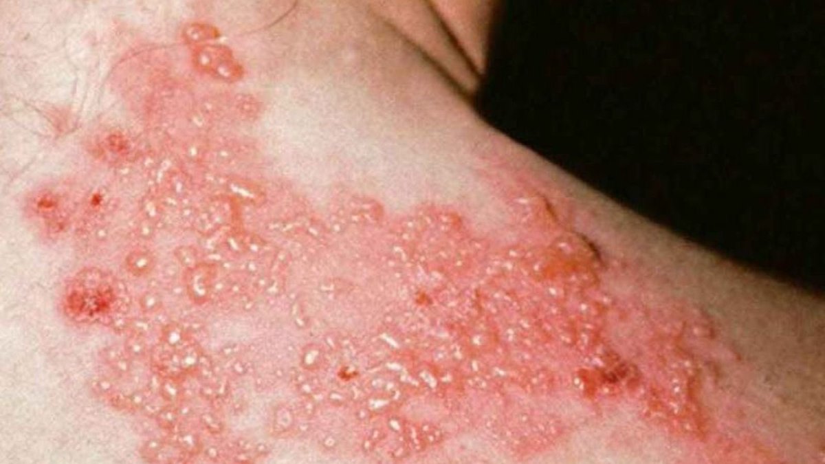 Covid mRNA aşılarının uzun dönem sonuçları yavaş yavaş geliyor. 

Yılın son yayınlarından birisi Hollanda’dan geldi. 

2.1 milyon insan verisi. 

COVID-19 mRNA aşı sonrası
Zona (Herpes Zoster) riski artıyor.

(Zona’nın ıstırabını çekene soracaksın!!!!)

%21 artış 

Yazarlar diyor