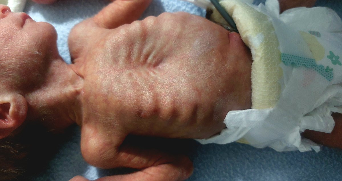 This is art
God's art
God is good🙏
My tiny 1.8 lbs patient👶🫶