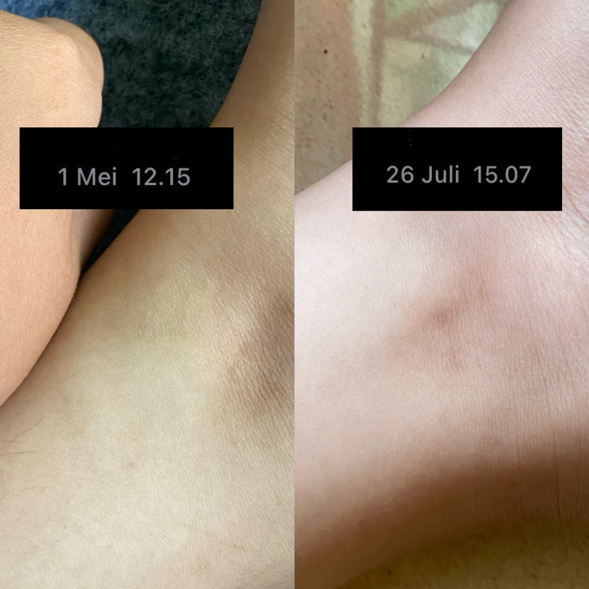 Lotion from a local brand... it really works that well on scars (jerawat item), making your skin smooth again like before 🥺👏🏻