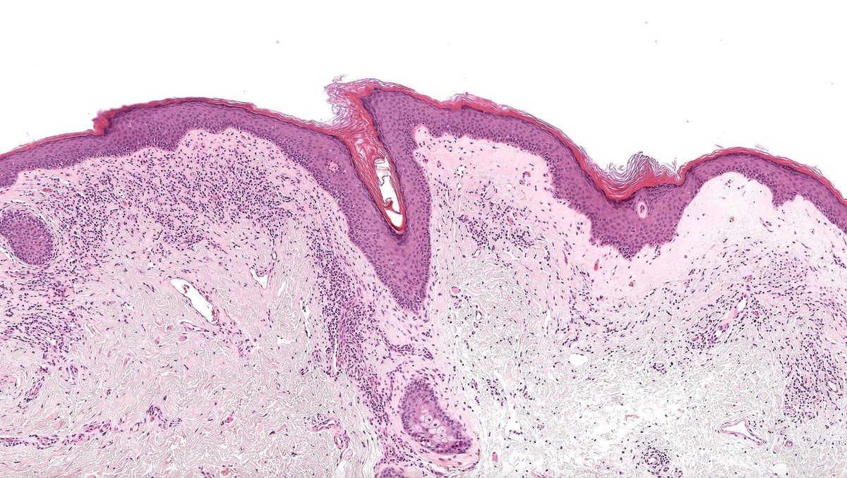 Can you make diagnosis from one pic, or #TooCloseToDiagnose?
Digital slide🔬 kikoxp.com/posts/17370 
Answer ✅ youtube.com/watch?v=bEaJux… 
#pathology #pathologists #pathTwitter #dermpath #dermatology #GYNpath #dermtwitter