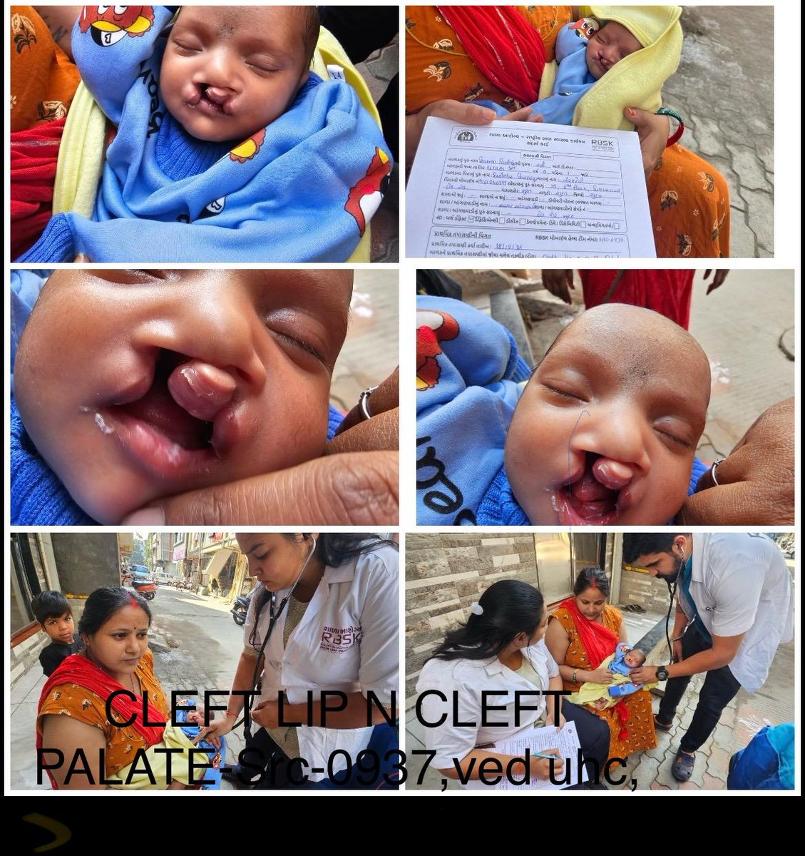 #RastriyaBalSwasthyaKaryakrm 
Sandarbh seva is given to a child having  Cleft lip &amp; cleft palate  is found during screening at Anganwadi by RBSKTeam src-0937, Ved UPHC, Surat Mun Corp <a href="/GujaratSHRBSK/">Gujarat SH (RBSK) Rashtriya Bal Swasthya Karyakram</a> <a href="/GujHealth/">Gujarat Health</a> <a href="/NHMGujarat/">NHM Gujarat</a> <a href="/MoHFW_INDIA/">Ministry of Health</a> #GujHFWDept <a href="/MoHFW_GUJARAT/">Ministry of Health</a> <a href="/MySuratMySMC/">My Surat</a>