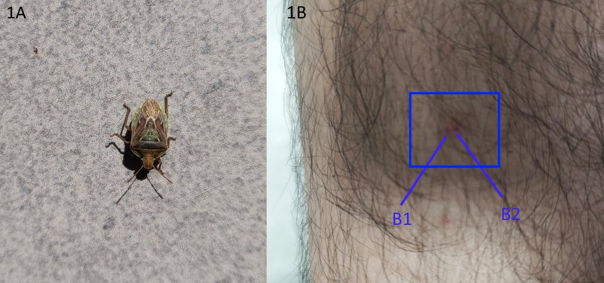 RevSociedad's tweet photo. #LiteratureNotice. Eduardo Faúndez. First bite case by Acledra dimidiaticollis (Spinola, 1852) (Heteroptera: Pentatomidae) on a human being.
https://t.co/6Ru8oniZfu https://t.co/fyH39EVusa