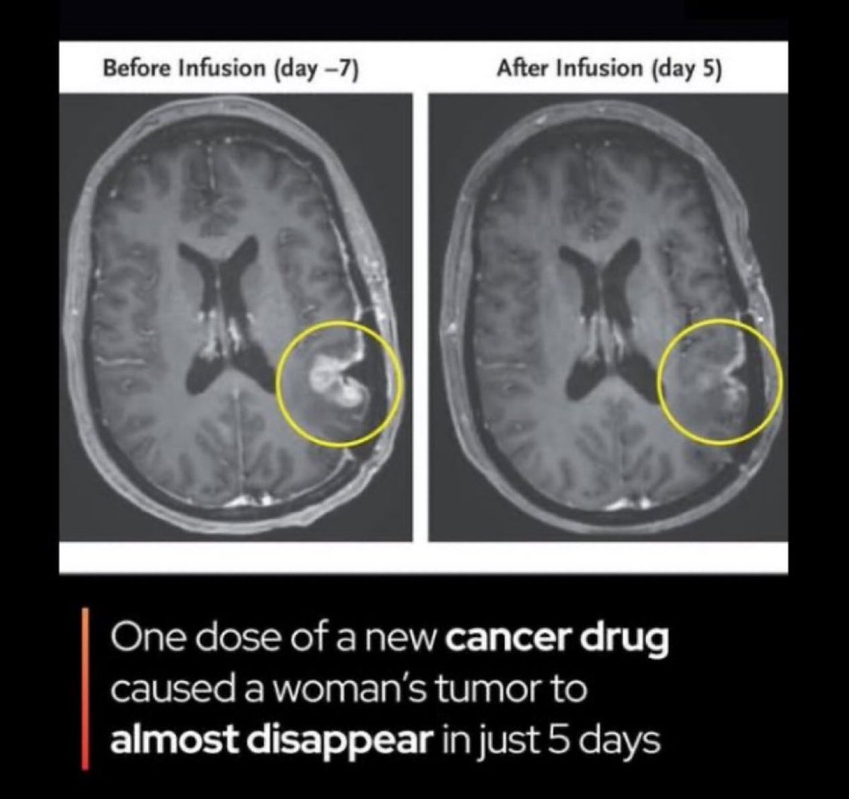 sciencegirl's tweet photo. A single dose of a new cancer drug made a brain tumor almost disappear - in just 5
 days

In early 2024, doctors at Massachusetts General Hospital treated three people with recurrent glioblastoma brain tumour  using a brand-new type of CAR T-cell therapy called CARv3-TEAM-E.

The treatment is made from each patient’s own immune cells, which are taken out, genetically rewired in the lab to recognize two different markers commonly found on glioblastoma cells, and then infused directly into the fluid spaces of the brain through a single procedure.

The results were stunning and much faster than anyone expected:

In one patient, MRI scans taken just five days after the single infusion showed the tumor had almost completely vanished.

A second patient had more than 60 % of the tumor disappear, and that shrinkage lasted for over six months.

The third patient also had clear tumor reduction within days.

These responses happened far more quickly and dramatically than anything seen before with immunotherapy for this type of brain cancer. Doctors described the early images as “jaw-dropping.