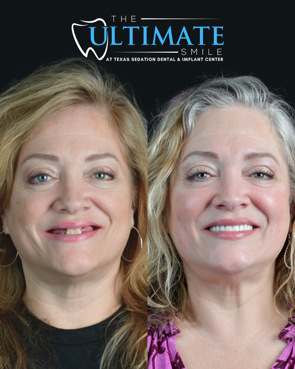 TXSedationDent's tweet image. A smile can change the way you feel about yourself, and this transformation says it all.

#dentalimplants #fixedteeth #newsmile #confidence #smilemakeover #TheUltimateSmile