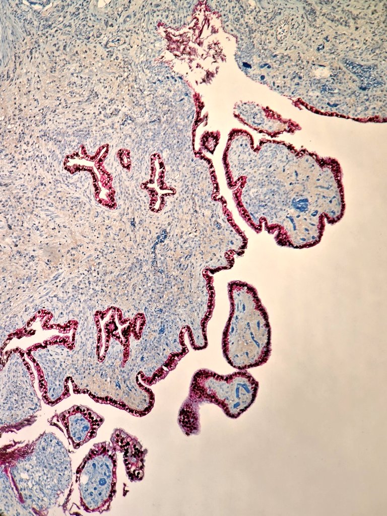 🔬 Nephrogenic metaplasia in bladder 

☑️Nonneoplastic reactive metaplastic lesion with tubular, glandular or papillary architecture.
☑️Most cases confined to lamina propria.
☑️May mimic urothelial carcinoma, clear cell or prostatic adenocarcinoma.

IHC : AE1/AE3 , PAX8 , 5S04 +