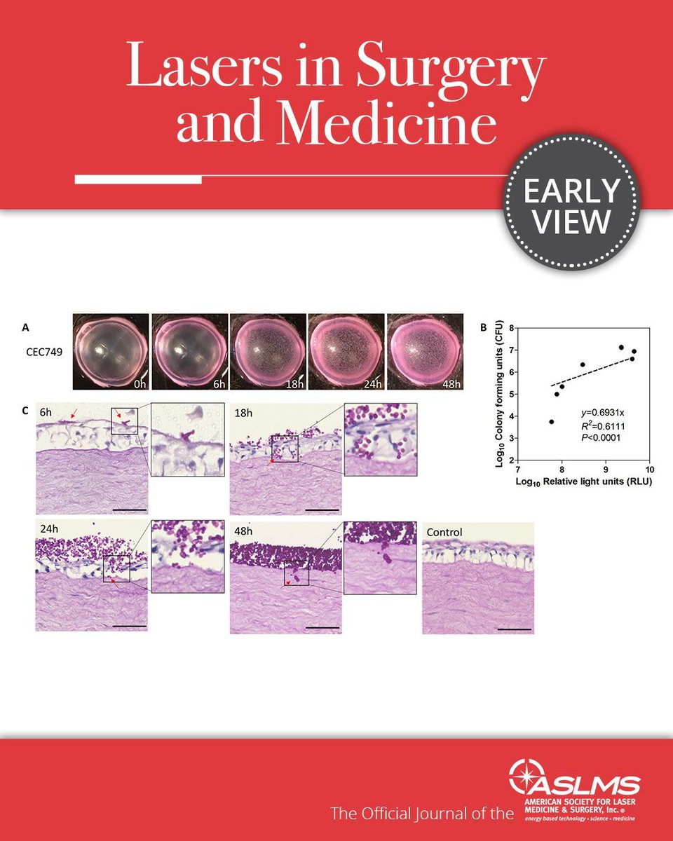 aslmsedu's tweet image. This basic science article assesses the efficacy of antimicrobial blue light (aBL) in managing Candida albicans keratitis in rabbit corneas ex vivo and safety to retinal cells in vitro... Members, read the full article at aslms.org/library?path=d…

#bluelight #keratitis #cornea