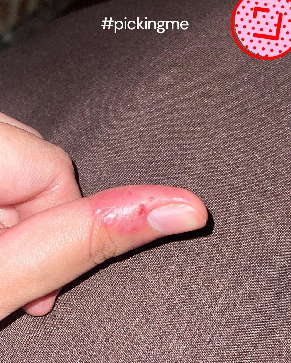 #PickingMe over #SkinPicking
"I feel insecure holding peoples hands because of it but I just can’t seem to stop even when I try to. No matter what I do I can’t help but pick." - Vivien, 20

Thank you for sharing Vivien! Read more stories at pickingme.org/shareyourstory ✨