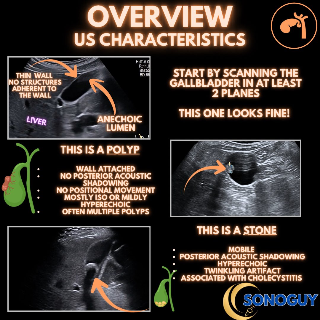 The_sonoguy's tweet image. 🎥 Gallbladder Polyps Under the Probe

Gallbladder polyps are fixed intraluminal lesions attached to the gallbladder wall.
Unlike stones, they don’t move with position change and don’t cast acoustic shadowing.

Most are benign — often cholesterol polyps —