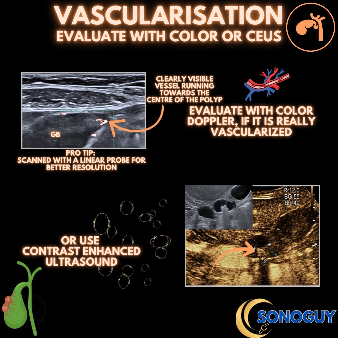 The_sonoguy's tweet image. 🎥 Gallbladder Polyps Under the Probe

Gallbladder polyps are fixed intraluminal lesions attached to the gallbladder wall.
Unlike stones, they don’t move with position change and don’t cast acoustic shadowing.

Most are benign — often cholesterol polyps —