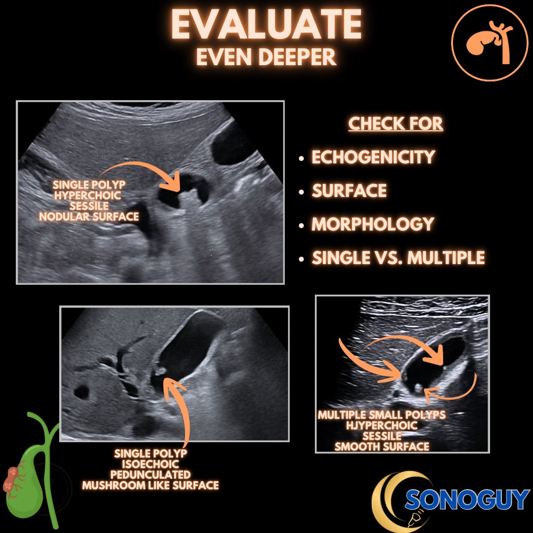 The_sonoguy's tweet image. 🎥 Gallbladder Polyps Under the Probe

Gallbladder polyps are fixed intraluminal lesions attached to the gallbladder wall.
Unlike stones, they don’t move with position change and don’t cast acoustic shadowing.

Most are benign — often cholesterol polyps —