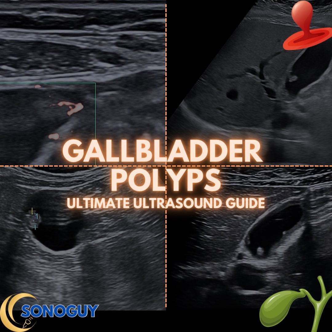 The_sonoguy's tweet image. 🎥 Gallbladder Polyps Under the Probe

Gallbladder polyps are fixed intraluminal lesions attached to the gallbladder wall.
Unlike stones, they don’t move with position change and don’t cast acoustic shadowing.

Most are benign — often cholesterol polyps —