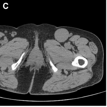 JVS - Venous and Lymphatic Disorders tweet media