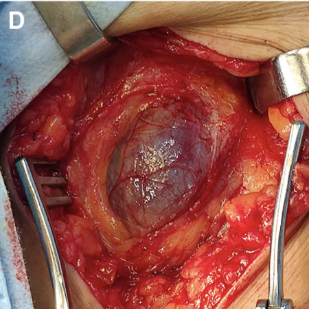 JVS - Venous and Lymphatic Disorders tweet media